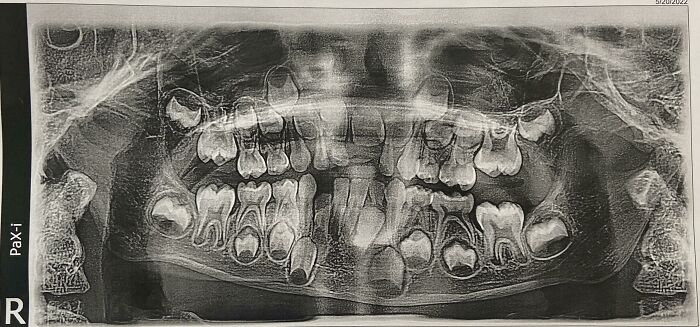 Radiografía dental mostrando estructura ósea y crecimiento de dientes en una imagen interesante del cuerpo humano.
