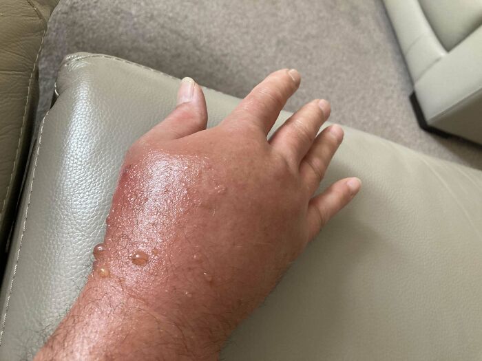 Mano humana con quemadura severa y ampollas sobre la piel, imagen curiosa del cuerpo humano.