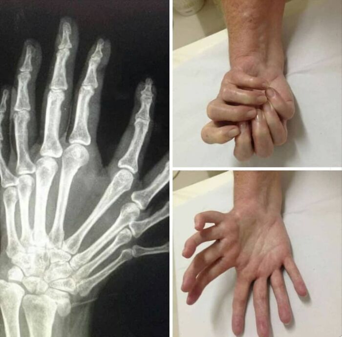 Radiografía y fotos médicas fascinantes de mano con deformidad y movilidad limitada en dedos para análisis clínico detallado.