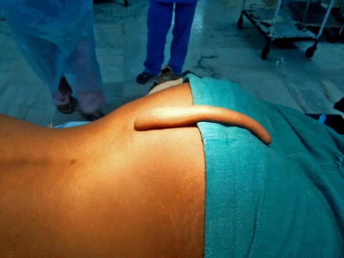 Paciente acostado con apéndice caudal, una de las fotos médicas tan fascinantes como inquietantes.