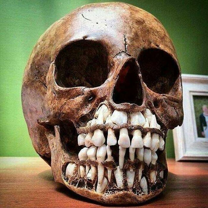 Cráneo con dientes superpuestos y permanentes en una imagen médica fascinante y inquietante.