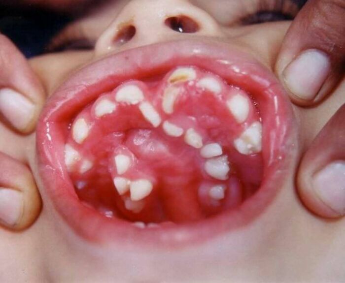 Boca con malformación dental grave mostrando dientes irregulares y encías inflamadas en fotos médicas inquietantes.