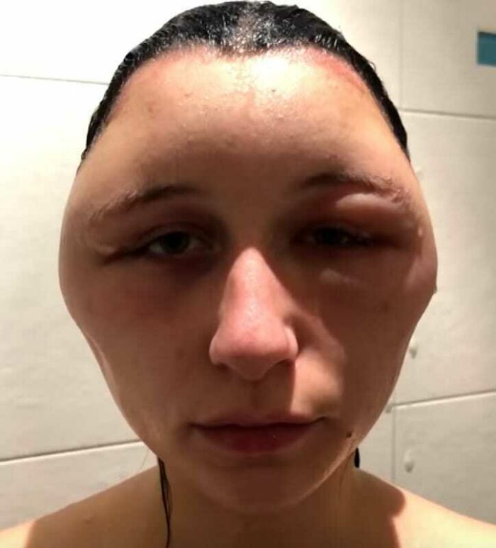 Rostro con inflamación extrema y deformación facial notable en foto médica fascinante e inquietante.