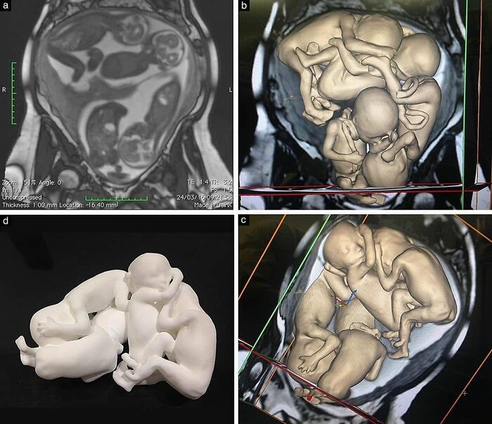 Imágenes médicas de fetos en gestación con detalles 3D fascinantes y anatómicos en resonancia magnética.