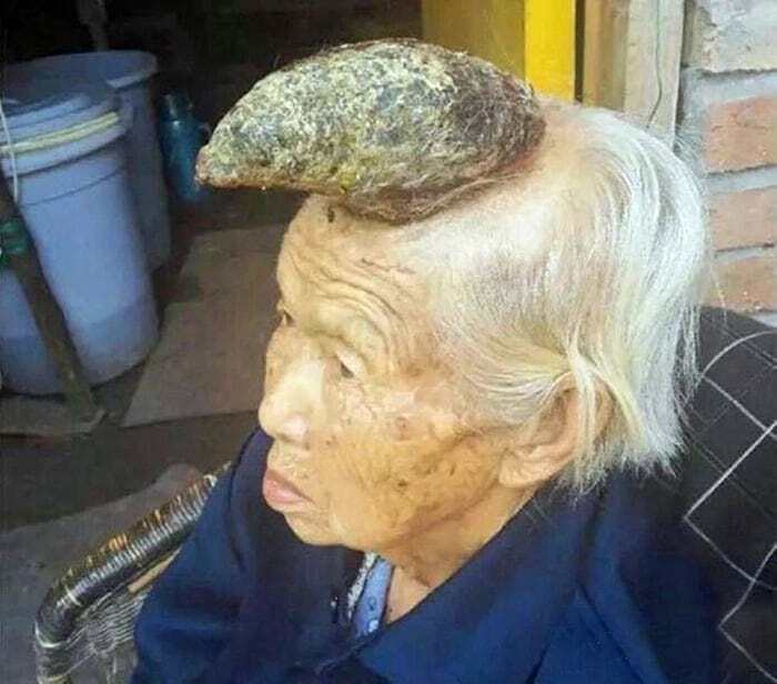 Foto médica inquietante de una persona con una gran protuberancia en la frente, imagen fascinante de biología humana.
