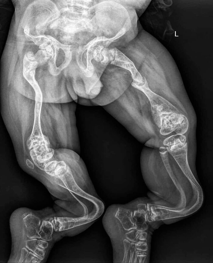 Radiografía médica fascinante muestra deformidad ósea congénita en extremidades inferiores humanas.