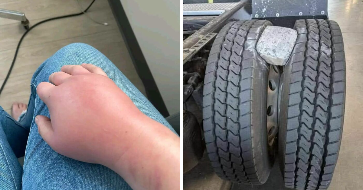 Mano hinchada en persona con jeans y rueda de camiu00f3n pinchada con piedra atrapada entre los neumu00e1ticos, cosas que salieron mal.
