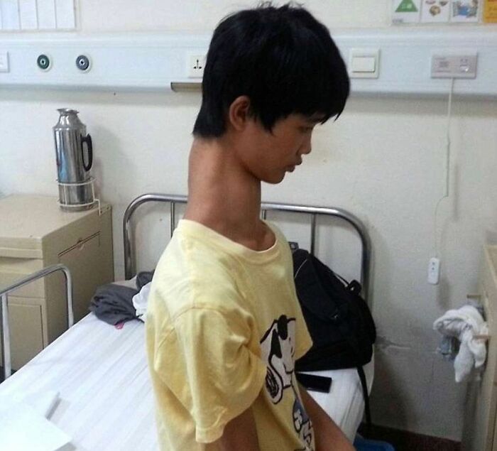Joven con deformidad médica sentada en cama de hospital, ejemplo impactante de fotos médicas que muestran el cuerpo aterrador.