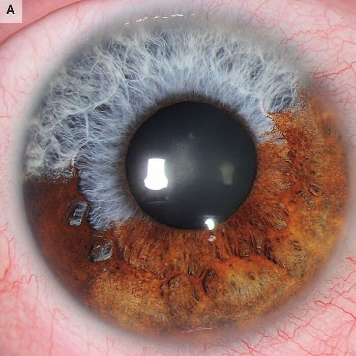 Ojo en primer plano mostrando detalles médicos y texturas del cuerpo en una imagen médica aterradora.