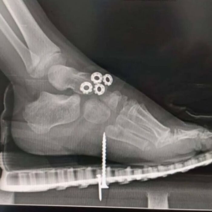 Radiografía médica de pie con tornillos y anillos metálicos mostrando intervención en el cuerpo y detalles aterradores.