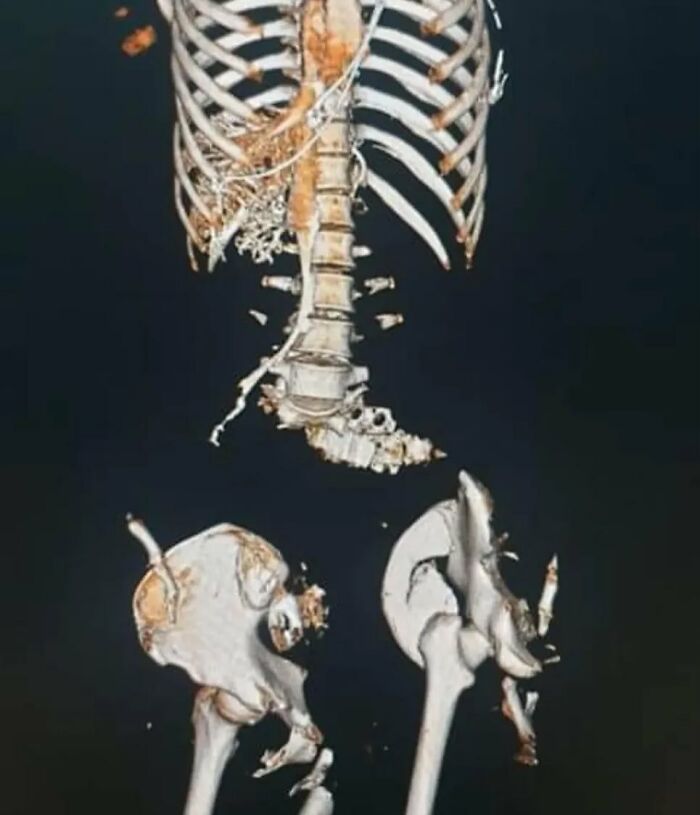 Radiografía médica que muestra fractura severa de columna y pelvis, demostrando que el cuerpo a veces es aterrador.