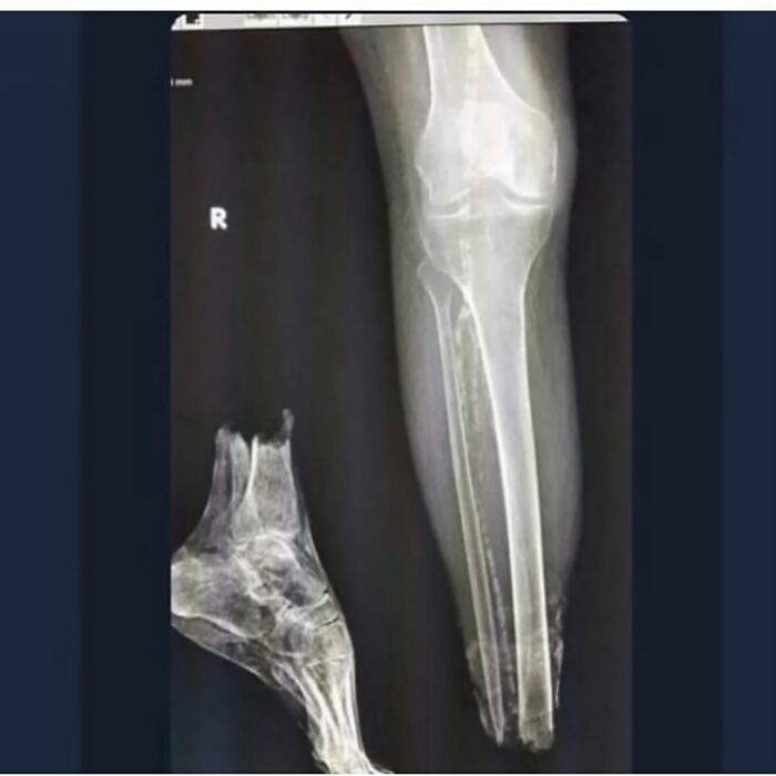 Radiografía médica del pie y la pierna mostrando una fractura compleja, ilustrando lo aterrador que puede ser el cuerpo humano.