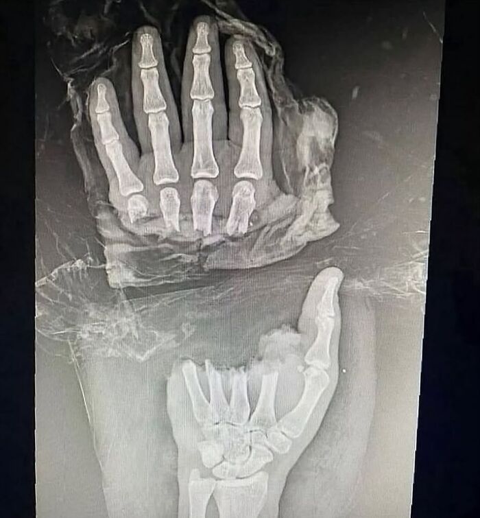 Radiografía médica mostrando manos con deformidades óseas, ilustrando lo aterrador que puede ser el cuerpo humano.