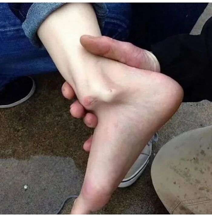 Pie de pie con una deformidad visible sostenido por una mano, mostrando una imagen médica que demuestra que el cuerpo puede ser aterrador.