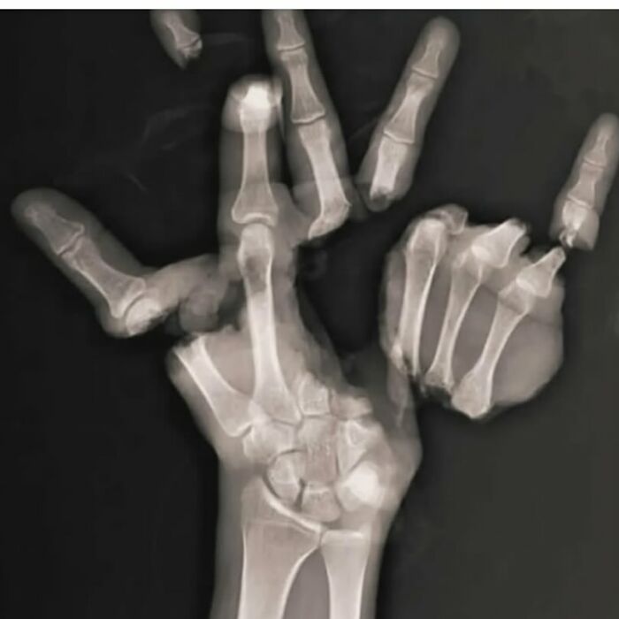 Radiografía médica mostrando deformación ósea intensa en mano humana, ilustrando el cuerpo a veces aterrador.