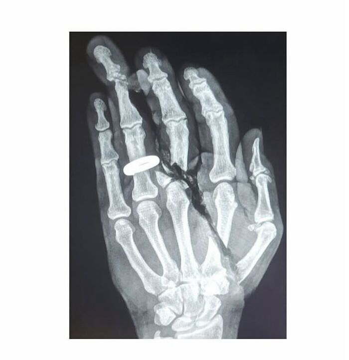 Radiografía de una mano con anillo y huesos fracturados, mostrando una imagen médica aterradora del cuerpo humano.