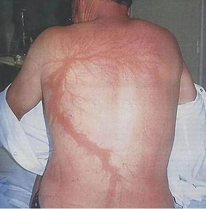 Marca de quemadura por rayo en la espalda de una persona, mostrando efectos médicos que demuestran que el cuerpo es aterrador.