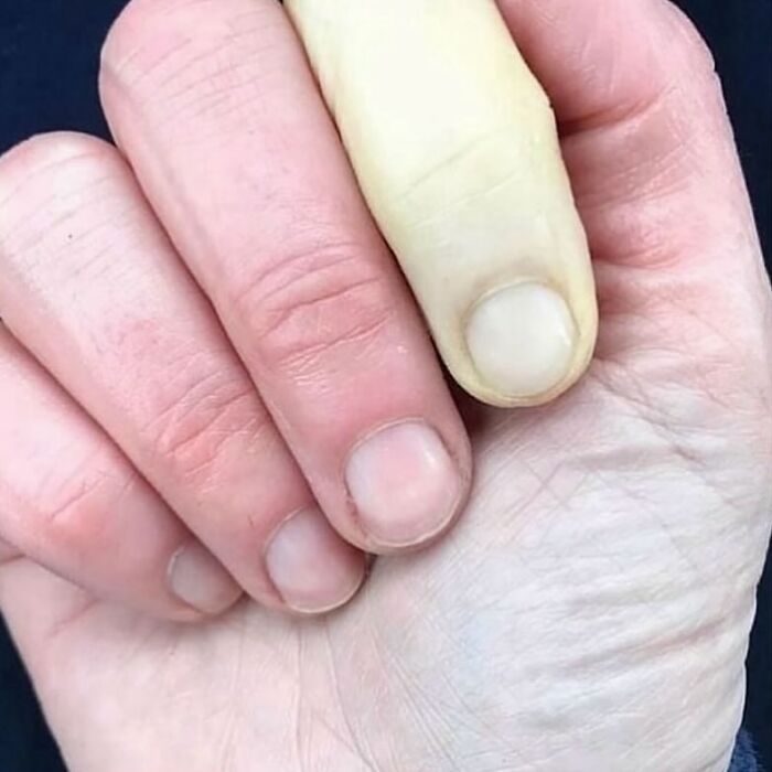 Mano con parte de la piel pálida y dedos con cambio de coloración, foto médica que muestra anomalías del cuerpo humano.