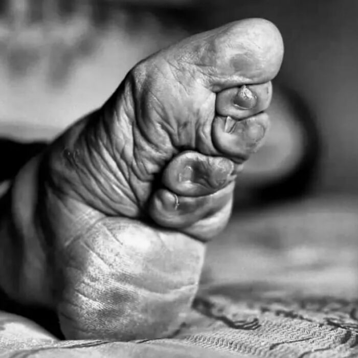 Pie de pie con deformidad visible, imagen médica que muestra el cuerpo en una condición aterradora y poco común.