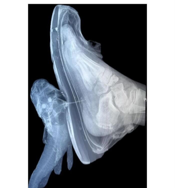 Radiografía del pie con zapato y objeto extraño metálico, mostrando una imagen médica que ilustra el cuerpo aterrador.