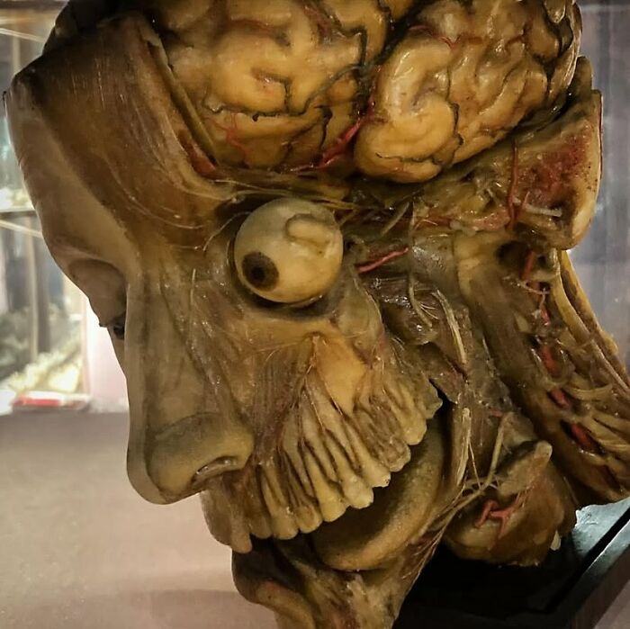Cabeza humana disecada mostrando tejido cerebral, nervios, vasos sanguíneos y estructura ósea en una imagen médica aterradora.