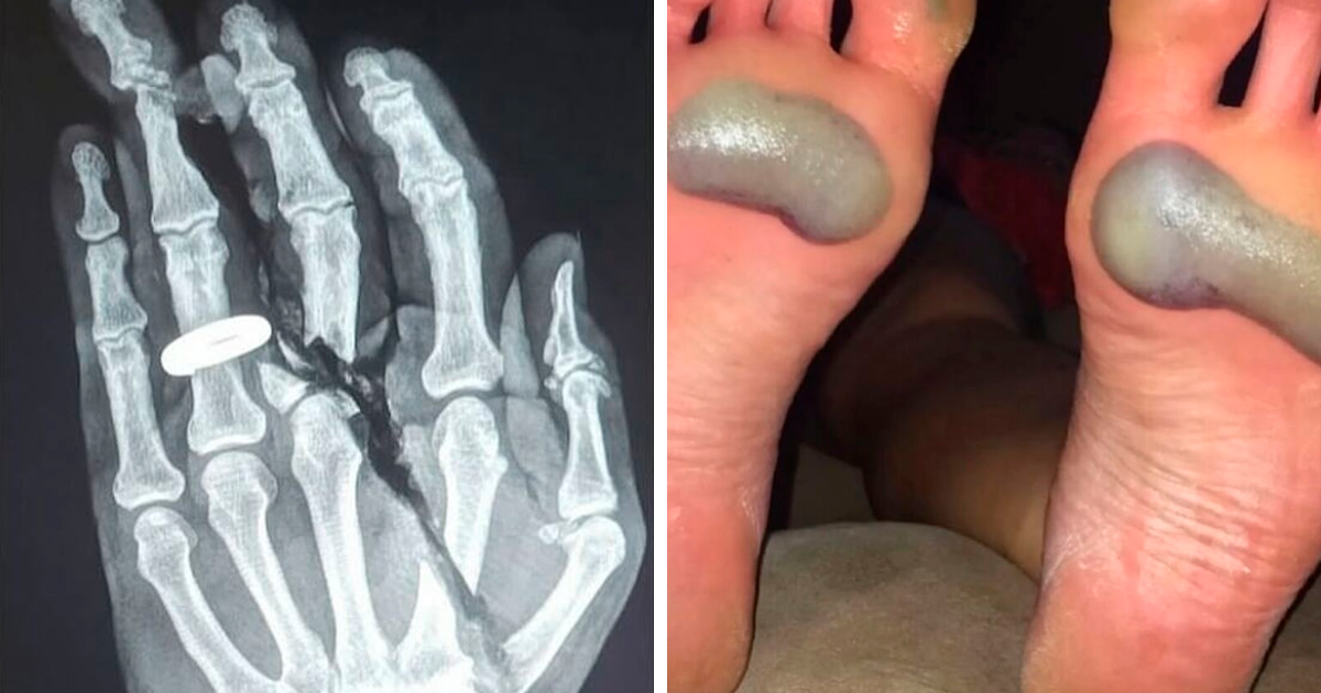 Radiografu00eda de mano fracturada y ampollas grandes en plantas de los pies mostrando fotos mu00e9dicas del cuerpo aterrador.