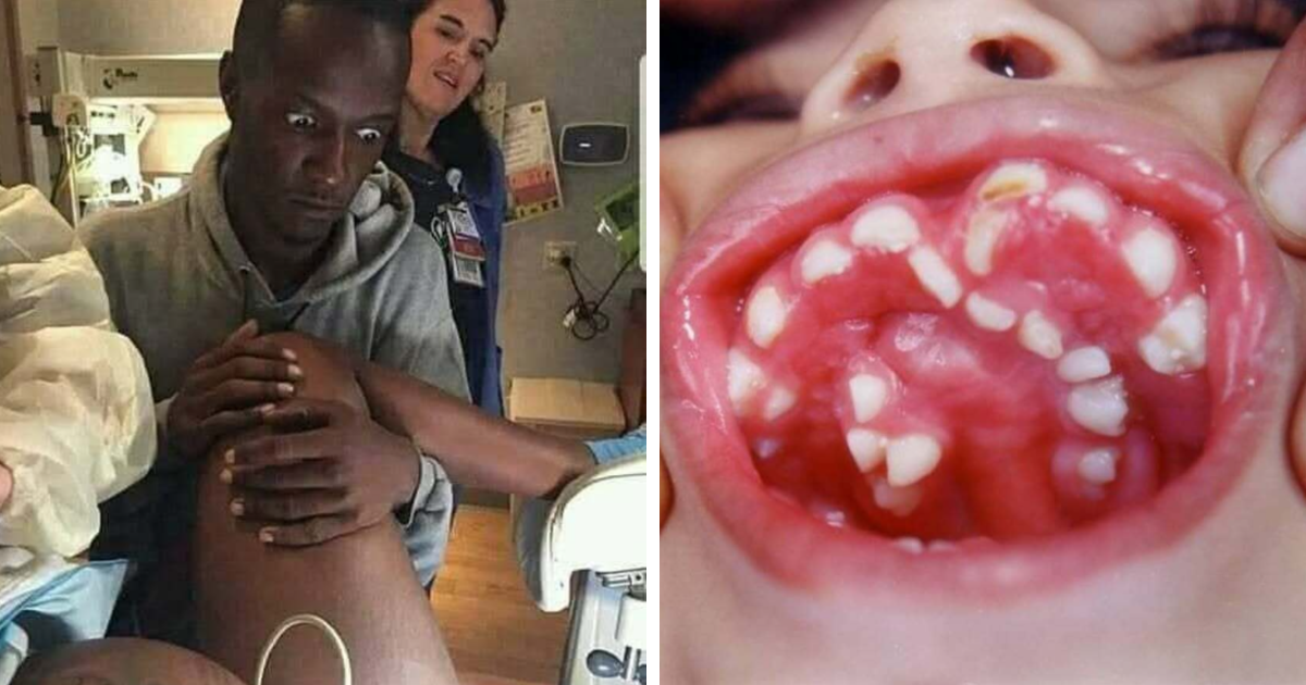 Hombre sorprendido durante examen mu00e9dico y close-up de boca con dientes y encu00edas irregulares en fotografu00edas mu00e9dicas.