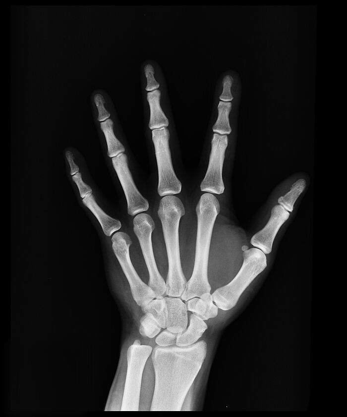 Radiografía de mano con dedos adicionales mostrando una característica única de la lotería genética en personas.