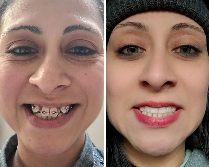 Primer plano de mujer mostrando cambio en apariencia dental con y sin brackets, pequeño cambio que marcó la diferencia.