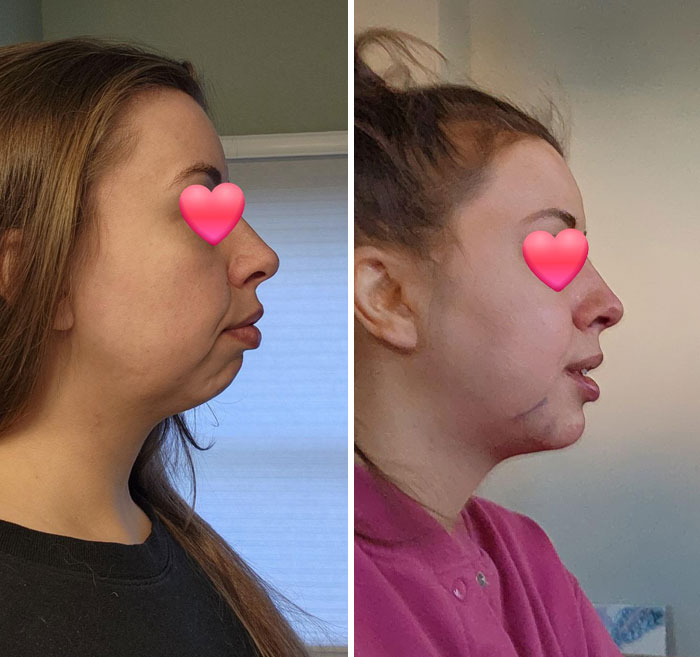 Mujer mostrando pequeños cambios de apariencia facial que marcaron la diferencia en su perfil y contorno.