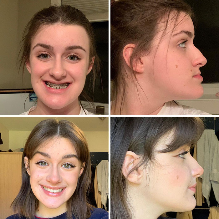 Antes y después de pequeños cambios de apariencia en mujeres que marcaron la diferencia en su sonrisa y perfil facial.