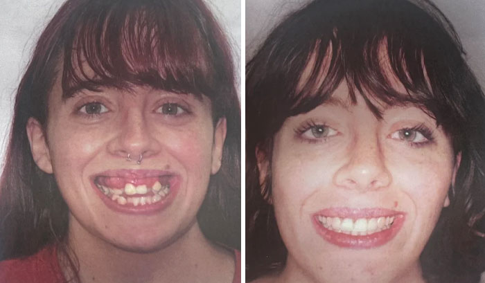 Mujer mostrando pequeños cambios de apariencia dental que marcaron la diferencia en su sonrisa y confianza.