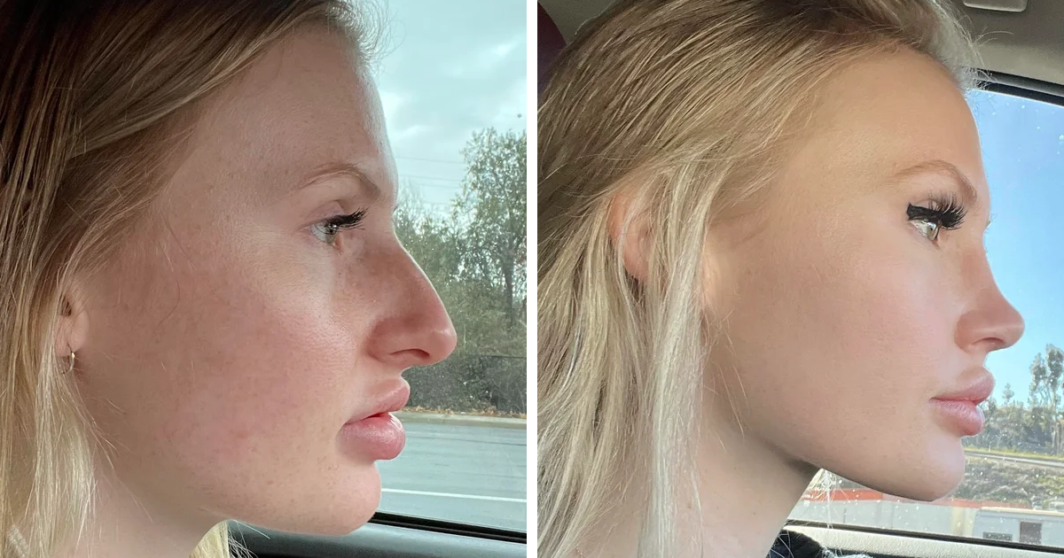 Mujer mostrando pequeu00f1os cambios de apariencia que marcaron la diferencia en su rostro perfil antes y despuu00e9s.