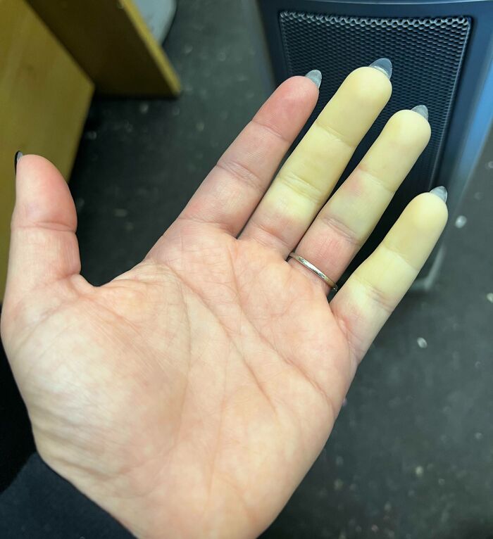 Mano con diferente coloración en los dedos, mostrando una curiosidad médica del cuerpo humano.