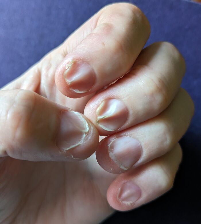 Mano con uñas dañadas y piel reseca, imagen curiosa del cuerpo humano mostrando detalles en las uñas y la piel.