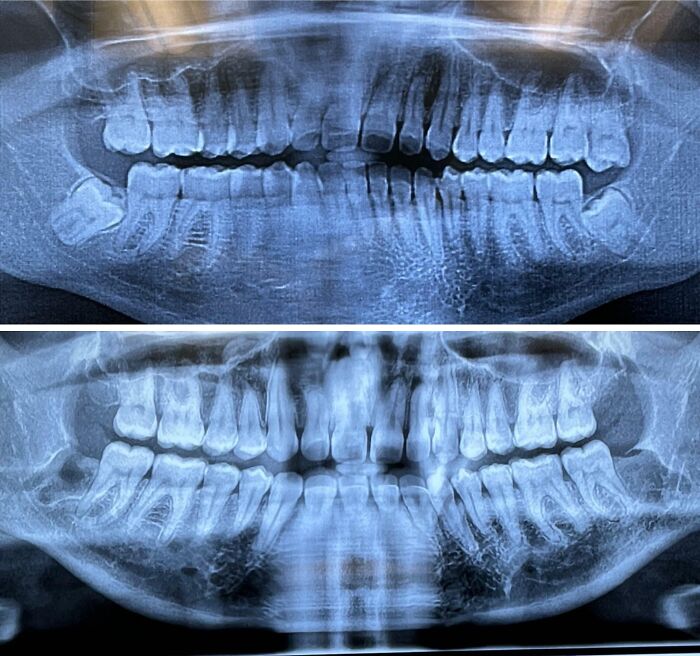 Radiografías dentales comparativas mostrando diferencias en estructura ósea y dientes, ofreciendo una nueva perspectiva del mundo.