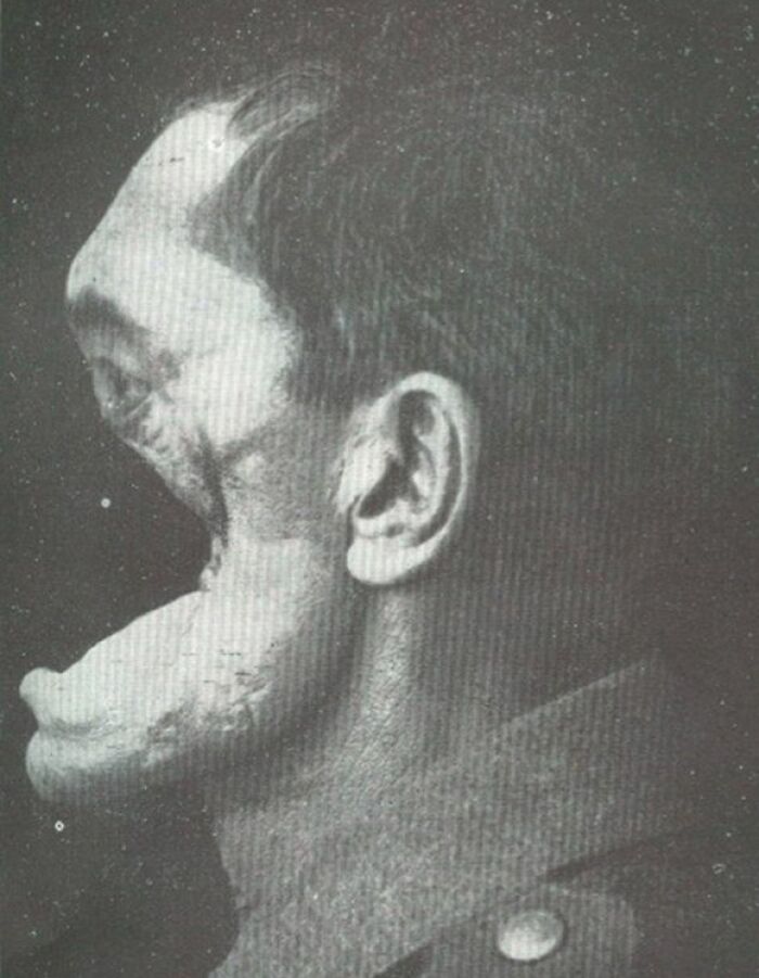 Hombre con deformidad facial en foto antigua mostrando imagen inquietante del pasado poco común.