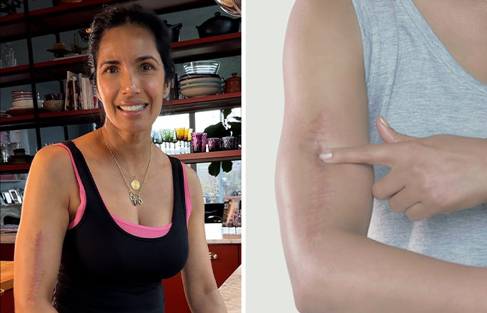 Mujer sonriente mostrando peculiaridad corporal en el brazo, destacando una cicatriz visible en un entorno interior.