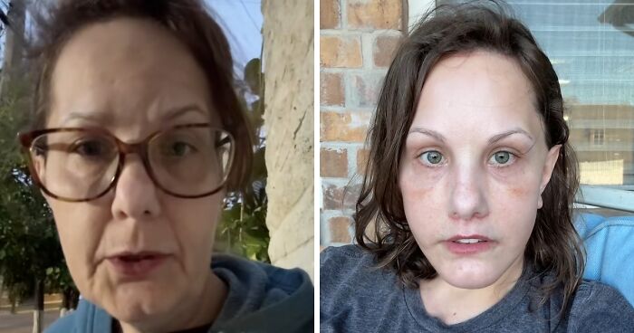 Los resultados del lifting facial que se hizo esta mujer por 15000$ han alucinado a todo internet