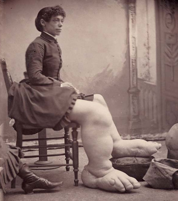 Mujer del pasado con una malformación en las piernas sentada en una silla, fotografía inquietante y antigua.