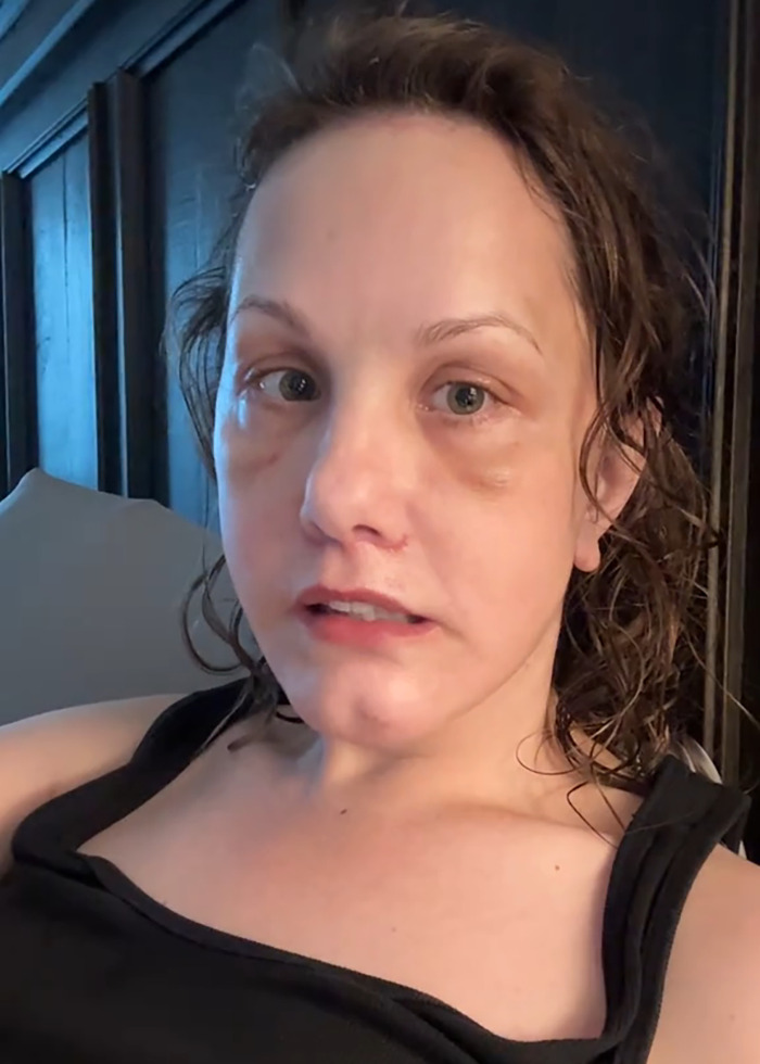 Primer plano de mujer mostrando su rostro con textura natural tras un lifting facial y proceso de cicatrización visible.