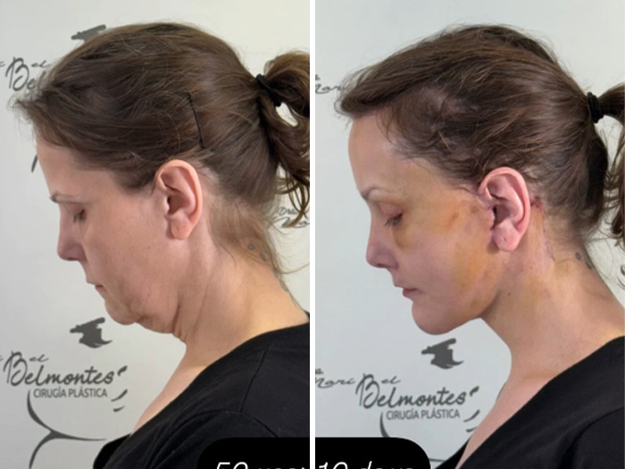 Transformación de lifting facial en mujer, mostrando resultados antes y después de cirugía plástica en perfil lateral.