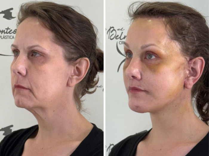 Antes y después del lifting facial en mujer, mostrando moretones visibles tras la cirugía como parte de los resultados.