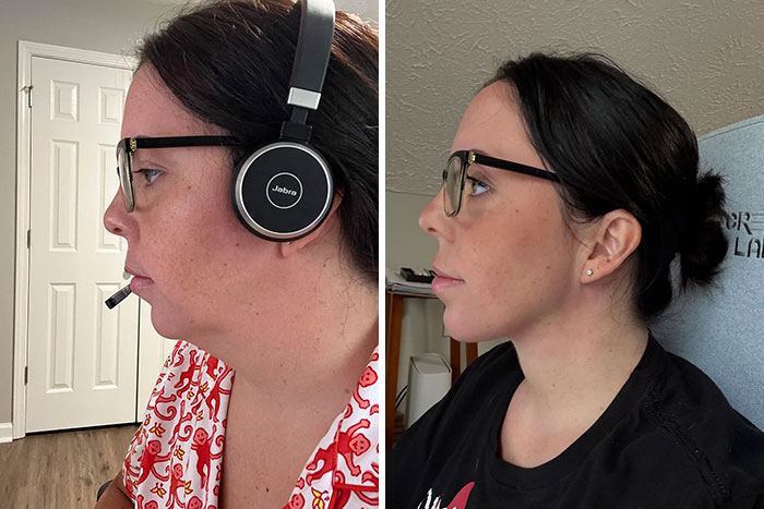 Antes y después de cirugía plástica en mujer con gafas, cambio visible en perfil facial y contorno del cuello.