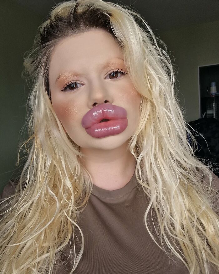 Mujer rubia con los labios más grandes del mundo, mostrando resultados de cirugías extremas de aumento labial.