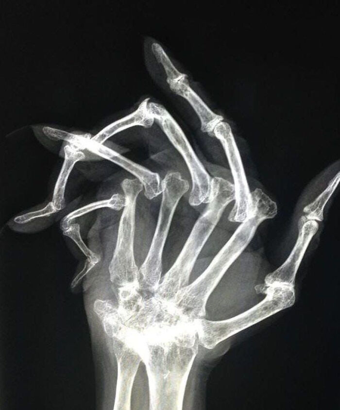 Radiografía médica de mano con deformaciones óseas visibles, mostrando una imagen aterradora del cuerpo humano.