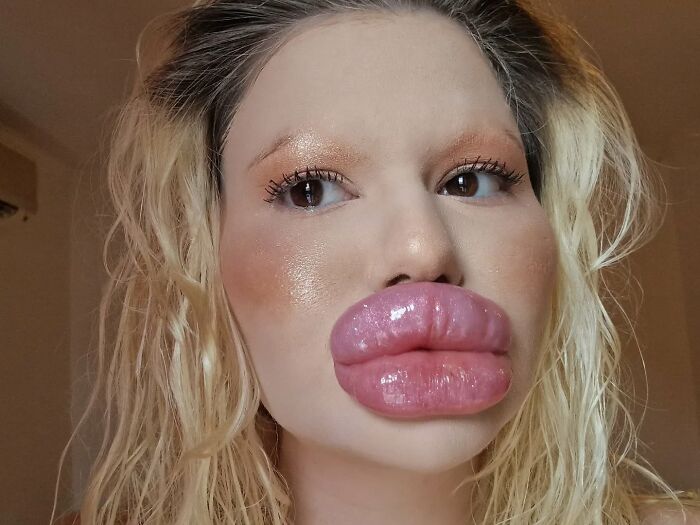 Mujer con los labios más grandes del mundo tras aumento extremo y resultados de cirugías estéticas cerca del rostro.