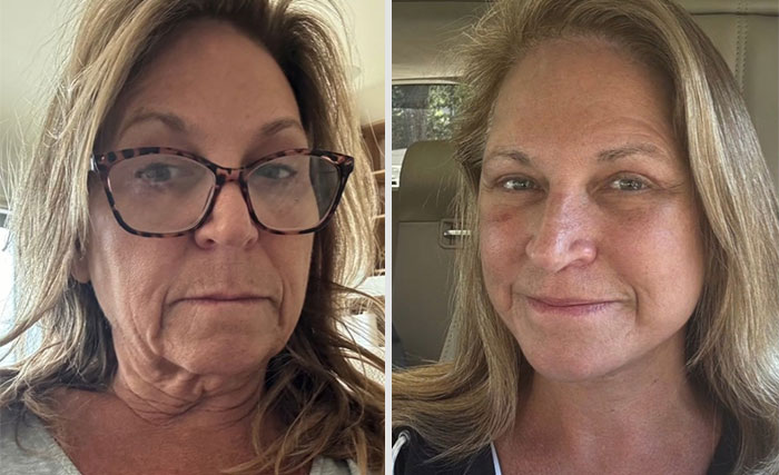 Mujer antes y después de cirugía plástica, mostrando resultados naturales y expresión de satisfacción con su apariencia.