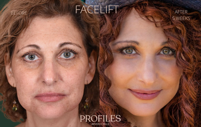 Mujer antes y después de cirugía plástica de lifting facial, mostrando resultados visibles y naturales en su rostro.