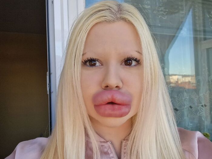 Mujer con los labios más grandes del mundo mostrando aumento extremo tras cirugías estéticas costosas.